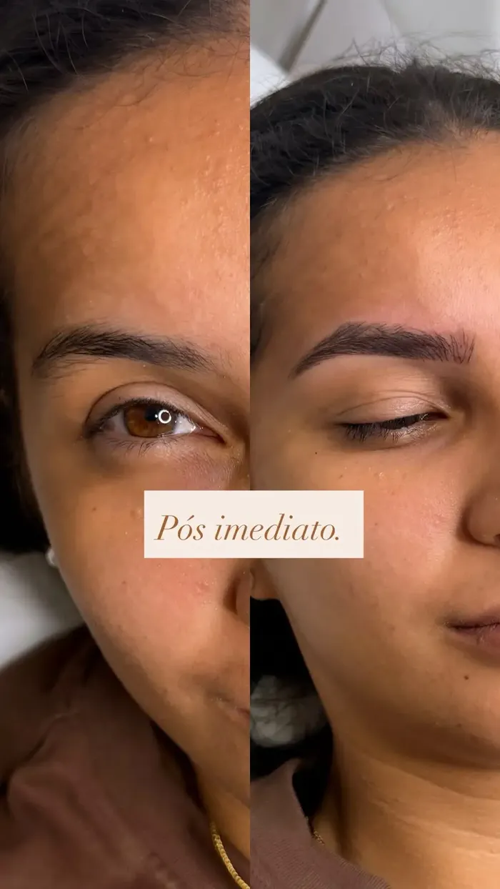 Antes e depois — pós imediato do Nanoblading fio a fio